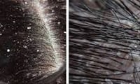 What's the difference between dandruff and dry scalp?